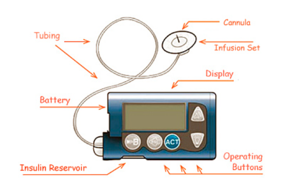 Image result for insulin pump