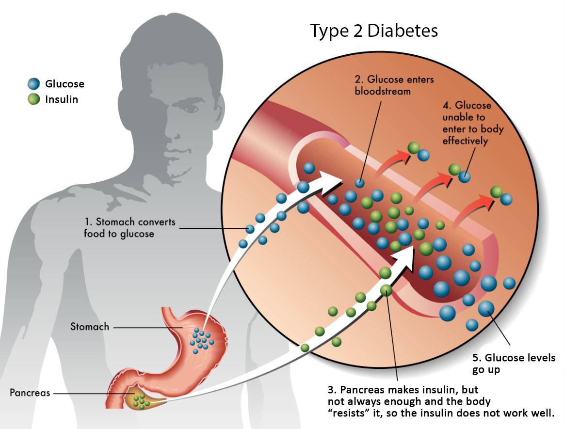 Zydus Hospitals Hyperglycemia refers to high levels of sugar or glucose in  the blood It occurs when the body does not produce or use enough insulin  which is a hormone that absorbs